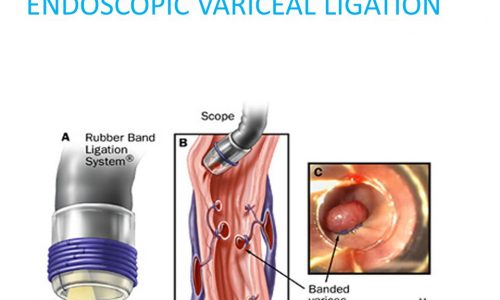 A rubber band is placed over the varix which. then undergoes thrombosis,sloughing,fibrosis.